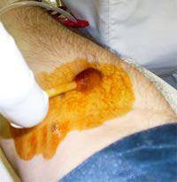 Povidone Iodine